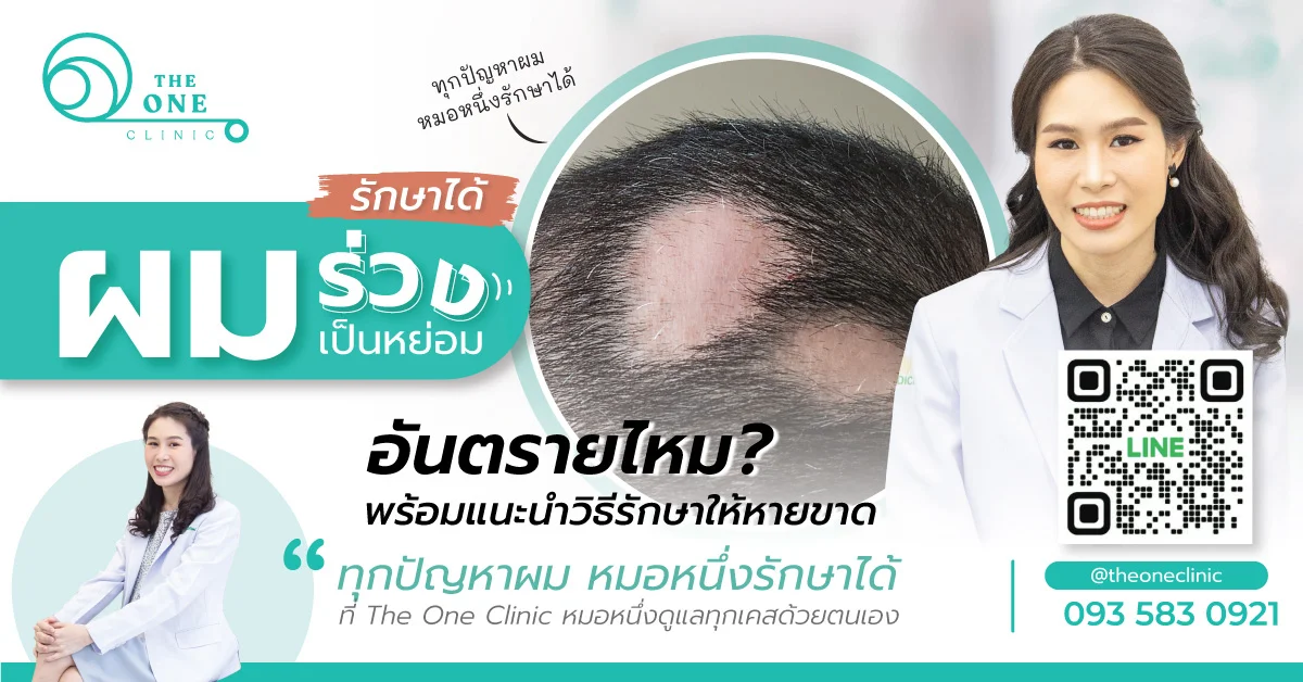 อาการ “ผมร่วงเป็นหย่อม” อันตรายไหม? พร้อมแนะนำวิธีการรักษา - The One Clinic